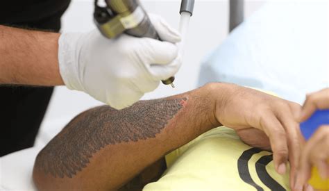 fastest tattoo removal.